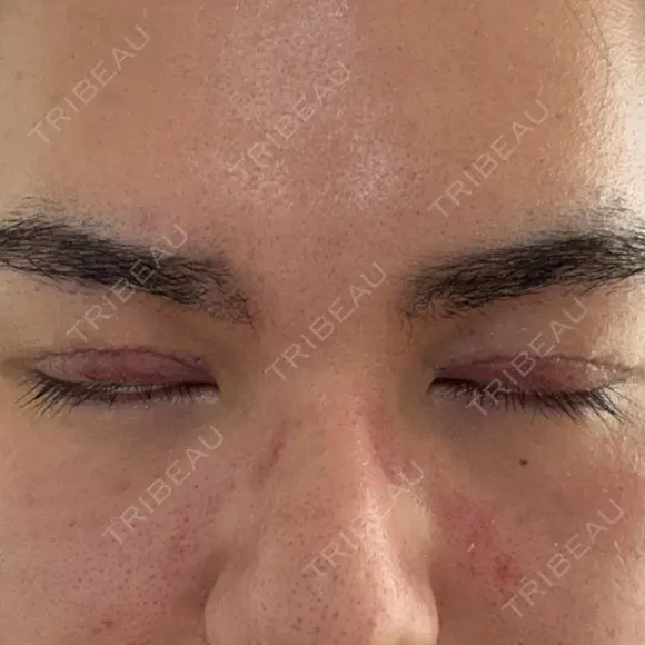 眼瞼下垂（切開） / 上まぶたの脂肪取り 新前橋かしま眼科形成外科クリニック DAY 5 メイン用