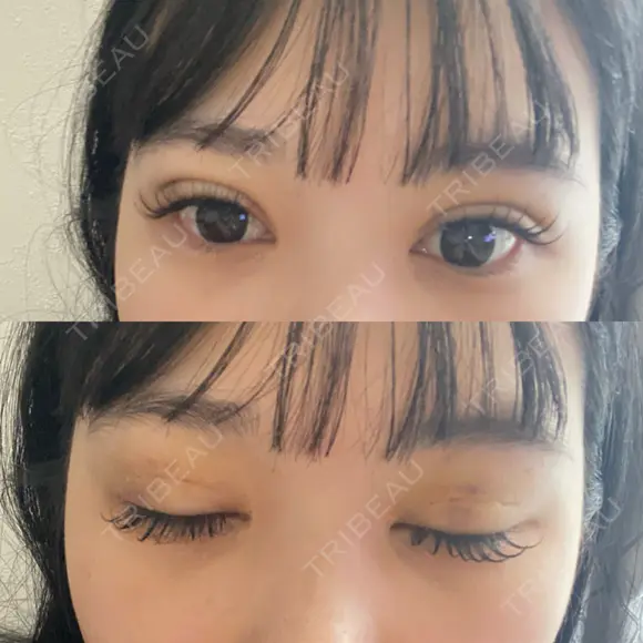 二重埋没 / RF（高周波）たるみ治療 Wing clinic 豊中駅前院 DAY 4 メイン用