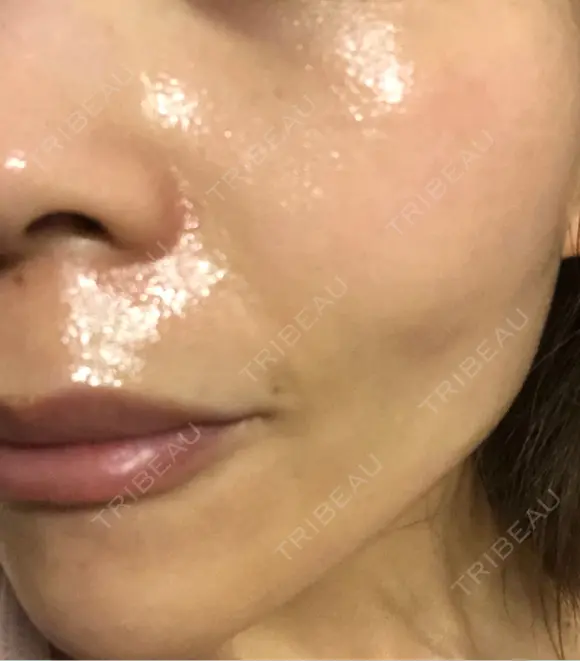 毛穴洗浄（ハイドラフェイシャルなど） / ルメッカ ON-CLINIC Beauty DAY 7 メイン用