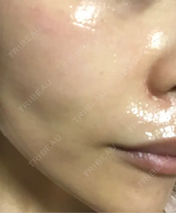 毛穴洗浄（ハイドラフェイシャルなど） / ルメッカ ON-CLINIC Beauty DAY 7 メイン用