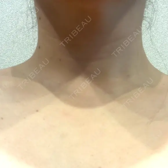 ボトックス（肩） 大美会クリニック 京都烏丸院 DAY 19 メイン用