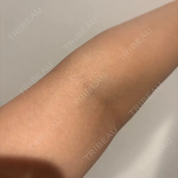 ボトックス（肩） / 高濃度ビタミンC点滴 小倉美容外科/美容皮膚科 ビラビューティークリニック AFTER メイン用