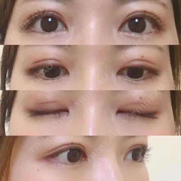 眼瞼下垂（切開） / 上まぶたの脂肪取り 白山クリニック 大分 DAY 23 メイン用