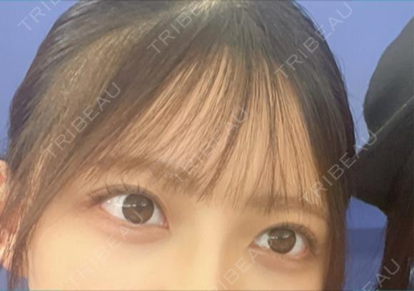 ヒアルロン酸注入（涙袋） eクリニック 横浜みなとみらい院 DAY 11 メイン用
