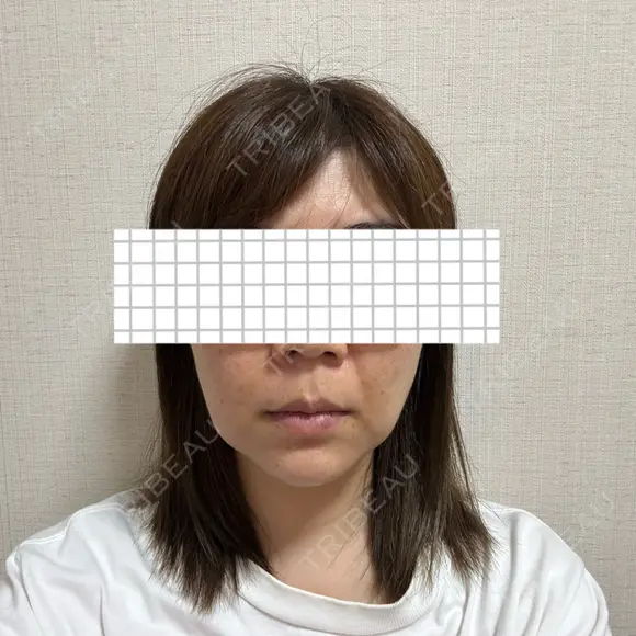 バッカルファット除去 アリエル美容クリニック 大宮院 DAY 28 メイン用
