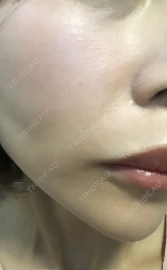 毛穴洗浄（ハイドラフェイシャルなど） / ルメッカ ON-CLINIC Beauty AFTER メイン用