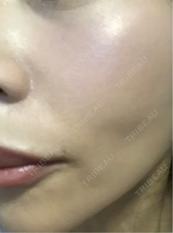 毛穴洗浄（ハイドラフェイシャルなど） / ルメッカ ON-CLINIC Beauty DAY 8 メイン用