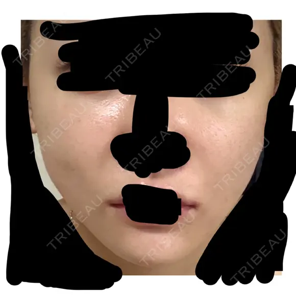 糸リフト / ボトックス（あご） / ボトックス（口角） / ボトックス（タレ目） / ボトックス（肩） / ボトックス（目尻） 東京シルククリニック 新宿院 AFTER メイン用