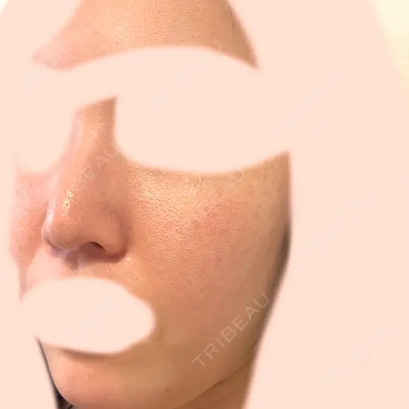 ピーリング（ハリ・ツヤ） 大美会クリニック 梅田院 DAY 0 メイン用