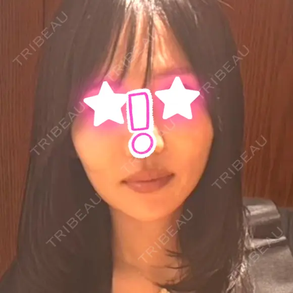 ヒアルロン酸注入（あご） / ヒアルロン酸注入（頬） / ヒアルロン酸注入（こめかみ） / ヒアルロン酸注入（鼻翼基部） DMTC CLINIC 日本橋院 AFTER メイン用