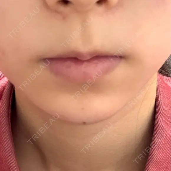 ヒアルロン酸注入（あご） KIMI CLINIC 形成・美容外科 DAY 0 メイン用