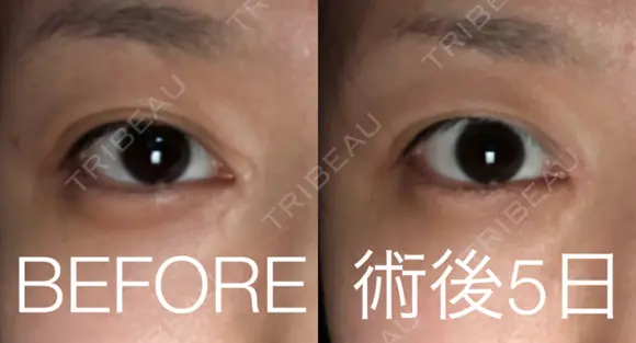 傷跡修正 / ほくろ・いぼ除去レーザー（肌） 山本クリニック DAY 5 メイン用