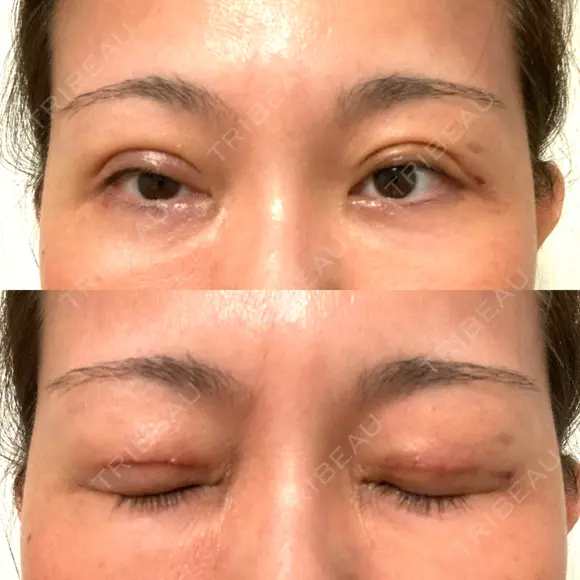 二重切開 水の森美容クリニック 大阪梅田院 DAY 8 メイン用