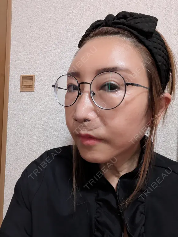 人中短縮 / ボトックス（人中） アネシス美容クリニック DAY 0 メイン用