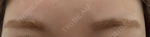 ヒアルロン酸注入（頬） / ボトックス（眉間） TCB東京中央美容外科 名古屋栄院 DAY 0 メイン用