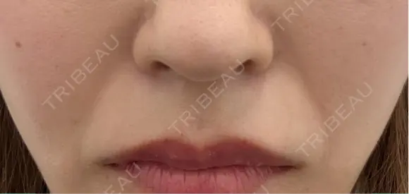 ヒアルロン酸注入（頬） / ボトックス（眉間） TCB東京中央美容外科 名古屋栄院 DAY 0 メイン用