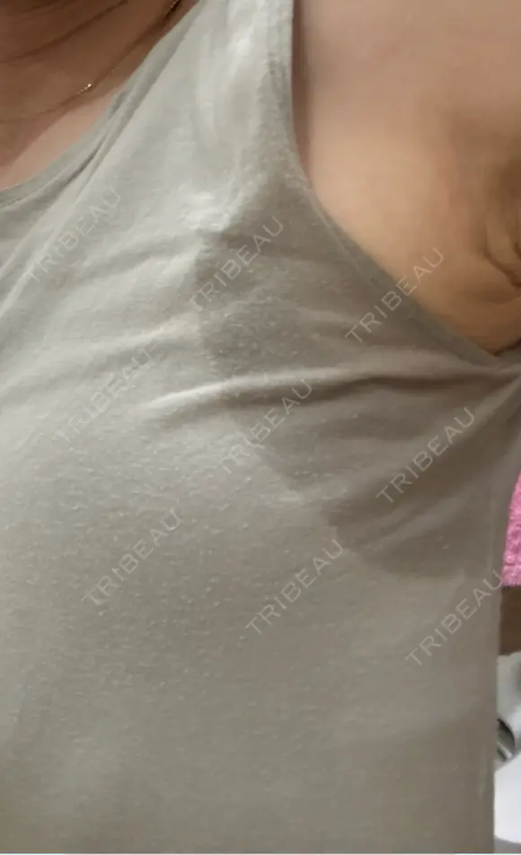 ワキ汗治療（切開） 石倉クリニック 水戸院 DAY 17 メイン用