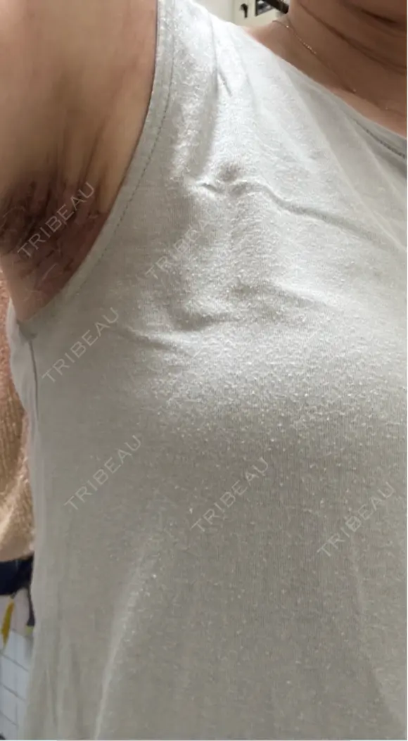 ワキ汗治療（切開） 石倉クリニック 水戸院 DAY 17 メイン用