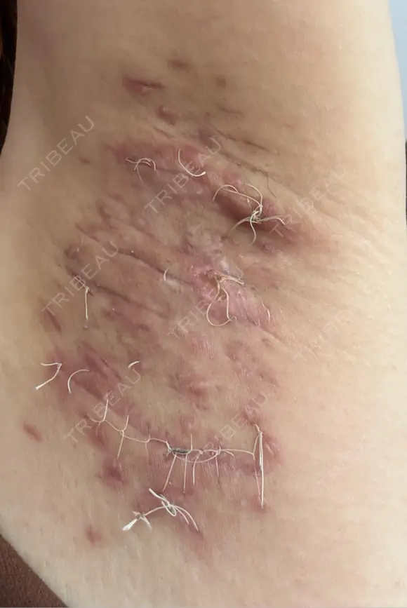 ワキ汗治療（切開） 石倉クリニック 水戸院 DAY 39 メイン用