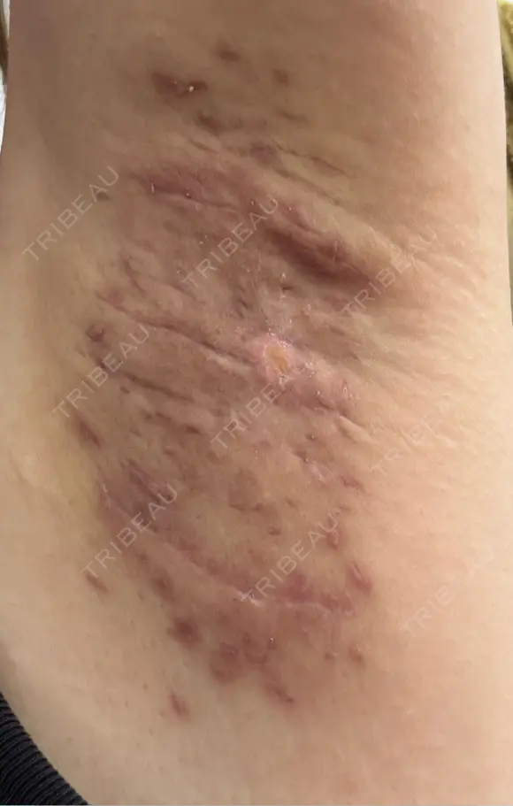 ワキ汗治療（切開） 石倉クリニック 水戸院 DAY 42 メイン用