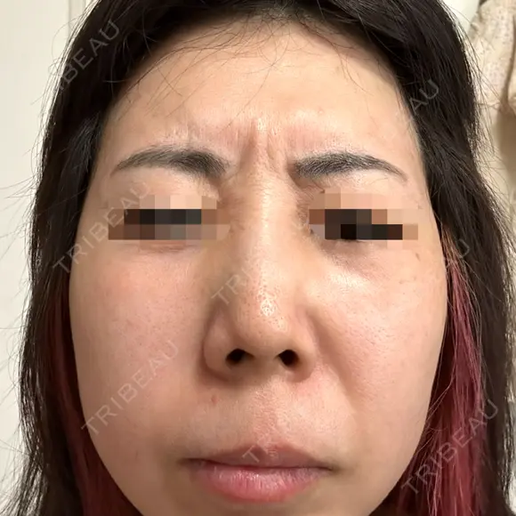 ボトックス（額） / その他（肌） 大美会クリニック 京都烏丸院 DAY 2 メイン用