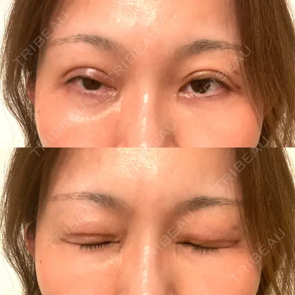 二重切開 水の森美容クリニック 大阪梅田院 DAY 9 メイン用