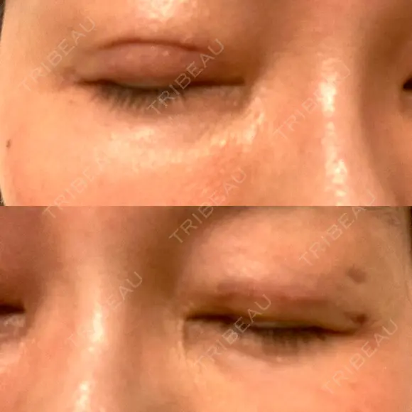 二重切開 水の森美容クリニック 大阪梅田院 DAY 9 メイン用