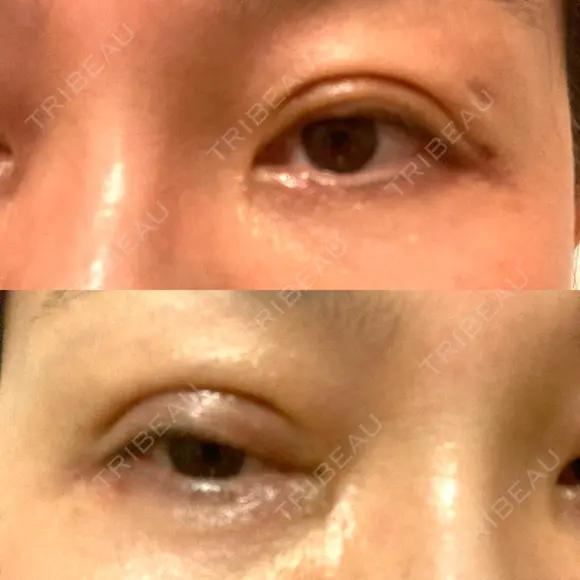二重切開 水の森美容クリニック 大阪梅田院 DAY 9 メイン用