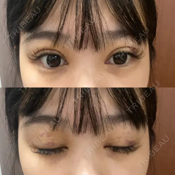 二重埋没 / RF（高周波）たるみ治療 Wing clinic 豊中駅前院 DAY 10 メイン用