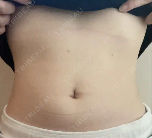 脂肪溶解注射（お腹） ミケイ医院 AFTER メイン用