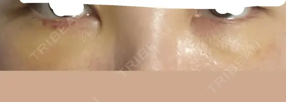 クマ治療 Kinshicho Beauty Clinic （錦糸町ビューティークリニック） AFTER メイン用