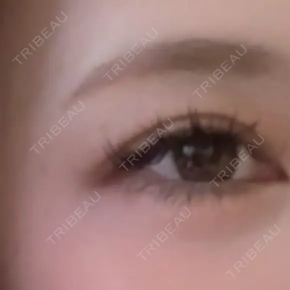 レーザートーニング（美白・肝斑） 渋谷美容外科クリニック 新橋院 DAY 3 メイン用