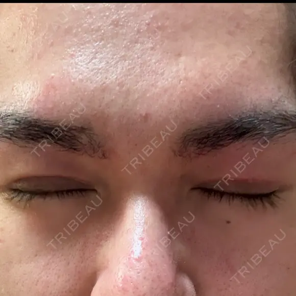 眼瞼下垂（切開） / 上まぶたの脂肪取り 新前橋かしま眼科形成外科クリニック DAY 12 メイン用