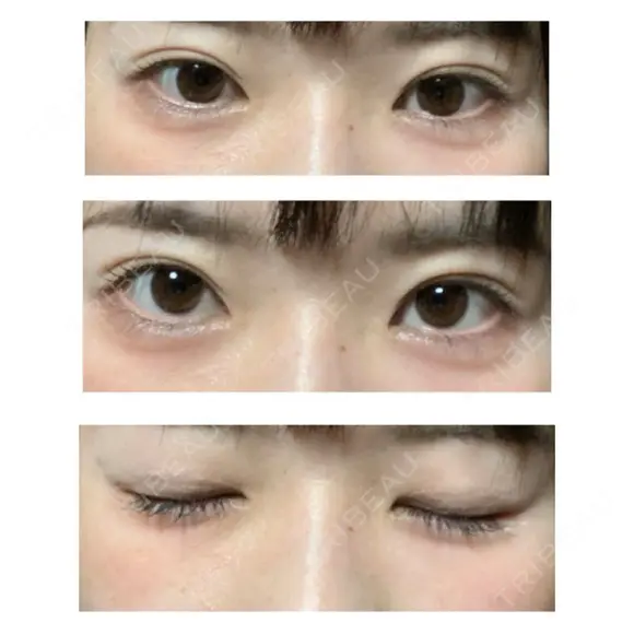 自然癒着法 / 眼瞼下垂（非切開） LUHO（ルホ）美容外科 AFTER メイン用