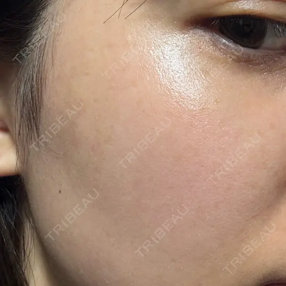 ピコスポット ビューティー和心クリニック 浅草院 AFTER メイン用