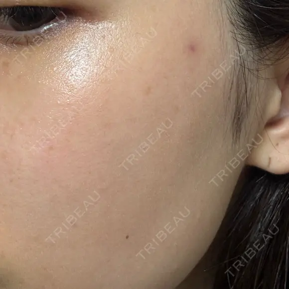 ピコスポット ビューティー和心クリニック 浅草院 DAY 7 メイン用