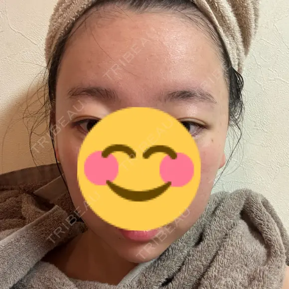 RF（高周波）たるみ治療 BITO BEAUTY CLINIC DAY 8 メイン用