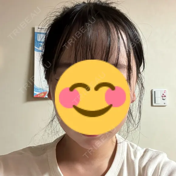 RF（高周波）たるみ治療 BITO BEAUTY CLINIC AFTER メイン用