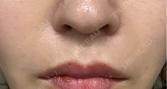 ヒアルロン酸注入（頬） / ボトックス（眉間） TCB東京中央美容外科 名古屋栄院 AFTER メイン用