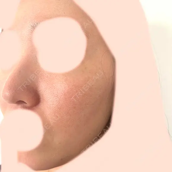 ピーリング（ハリ・ツヤ） 大美会クリニック 梅田院 AFTER メイン用