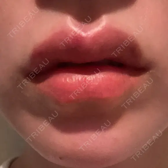 ヒアルロン酸注入（唇） AZ BEAUTY CLINIC DAY 1 メイン用