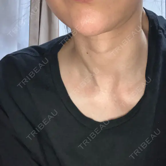 肌ヒアルロン酸注入（たるみ・シワ改善） / ピコレーザートーニング（美白・肝斑） 渋谷美容外科クリニック 横浜院 AFTER メイン用