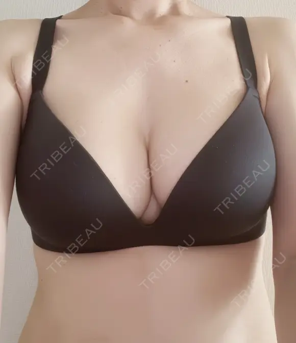 豊胸（シリコンバッグ） / 胸修正 お茶の水美容形成クリニック AFTER メイン用