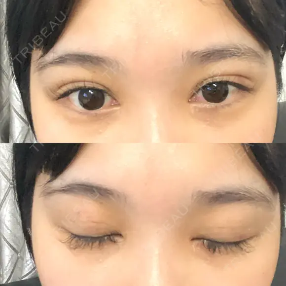 二重埋没 / RF（高周波）たるみ治療 Wing clinic 豊中駅前院 DAY 14 メイン用
