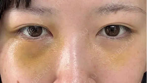 クマ治療 / 下まぶたたるみ取り / 下まぶたの脂肪取り APOLLO BEAUTY CLINIC DAY 4 メイン用