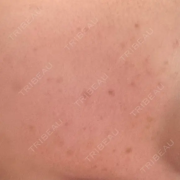 ルメッカ ON-CLINIC Beauty AFTER メイン用