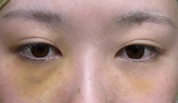 クマ治療 / 下まぶたたるみ取り / 下まぶたの脂肪取り APOLLO BEAUTY CLINIC DAY 5 メイン用