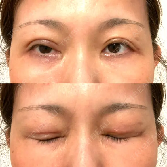 二重切開 水の森美容クリニック 大阪梅田院 DAY 15 メイン用