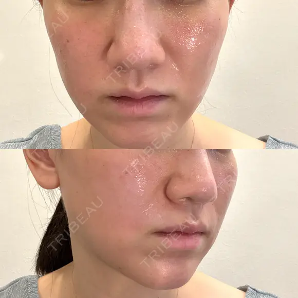 毛穴洗浄（ハイドラフェイシャルなど） / ポテンツァ ルラ美容クリニック 京都院 DAY 0 メイン用