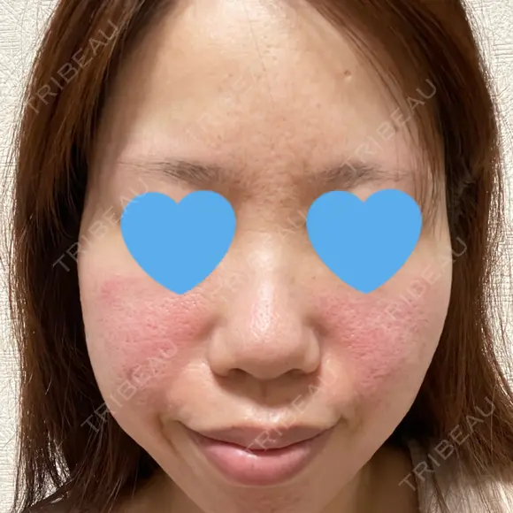 ボトックス（エラ・小顔） / ヒアルロン酸注入（鼻翼基部） 目白ホワイトクリニック DAY 0 メイン用